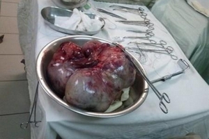 Thừa Thiên - Huế: Phẫu thuật cắt bỏ khối u gần 5 kg