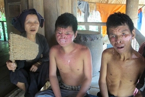 Hòa Bình: Con nhà nghèo "đeo" bệnh lạ