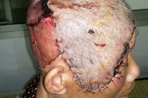 Quảng Nam: Cứu sống bệnh nhân ung thư tế bào đáy nguy kịch