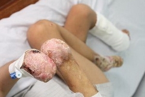 Phát hiện bệnh gây hoại tử tứ chi tại TP Hồ Chí Minh