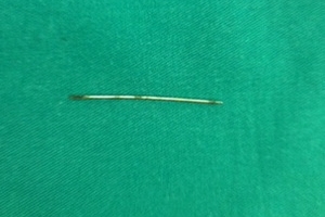 Cứu sống 1 bệnh nhân bị kim đâm vào tim hiếm gặp