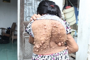 Nghệ An: Cô gái mang hàng nghìn khối u suốt hơn 30 năm