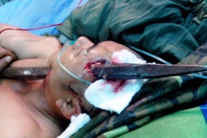 Đang đào đất, bất ngờ bị xà beng đâm xuyên đầu