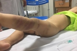 Cháu bé hơn 1 tuổi bị bạo hành chấn thương sọ não được xuất viện
