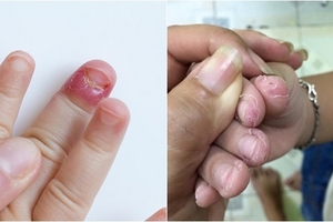 Thấy con có tật cắn móng tay, người mẹ đưa con đi khám và phát hiện ra sự thật gây sốc!