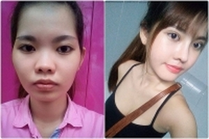 Cô gái xinh như hot girl sau khi hạ gò má, gọt hàm, nâng mũi, trượt cằm