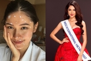 Á hậu Thùy Dung bất ngờ bị bệnh thủy đậu trước thềm chung kết Hoa hậu Quốc tế 2017