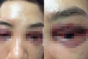 Vụ ‘tố’ làm hỏng mí mắt khi phẫu thuật: ‘Tôi không muốn làm to chuyện, hai bên đã hòa giải’