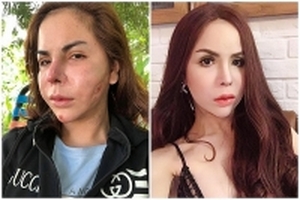 Bác sĩ nói gì về khuôn mặt bị biến dạng sau khi nạo silicon của hotgirl Linda?