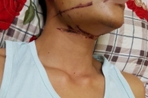 Đi cấp cứu vì vướng phải dây cáp viễn thông giăng ngang đường