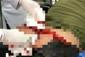 Ngồi xổm khiến bồn cầu bị sập, nam thanh niên nặng gần 1 tạ bị cắt đứt mông