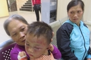 Bé trai 2 tuổi bị bầm tím mặt nghi bị bố dượng bạo hành