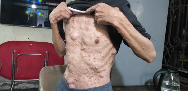 Ông Hoàng Thanh Tao – nạn nhân chất độc da cam trú tại phường Thành Vinh, tỉnh Nghệ An, dù mang trong mình nhiều căn bệnh do di chứng nhiễm chất độc hóa học vẫn kiên cường mưu sinh bằng nghề gói bánh chưng.